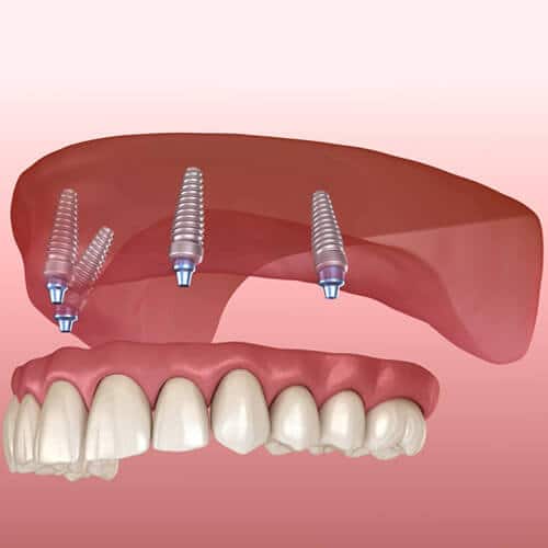 alta canyon dental sandy ut services implant supported dentures image