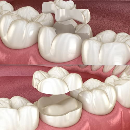 alta canyon dental sandy ut services inlays and onlays images