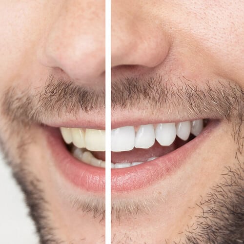 alta canyon dental sandy ut services teeth whitening images