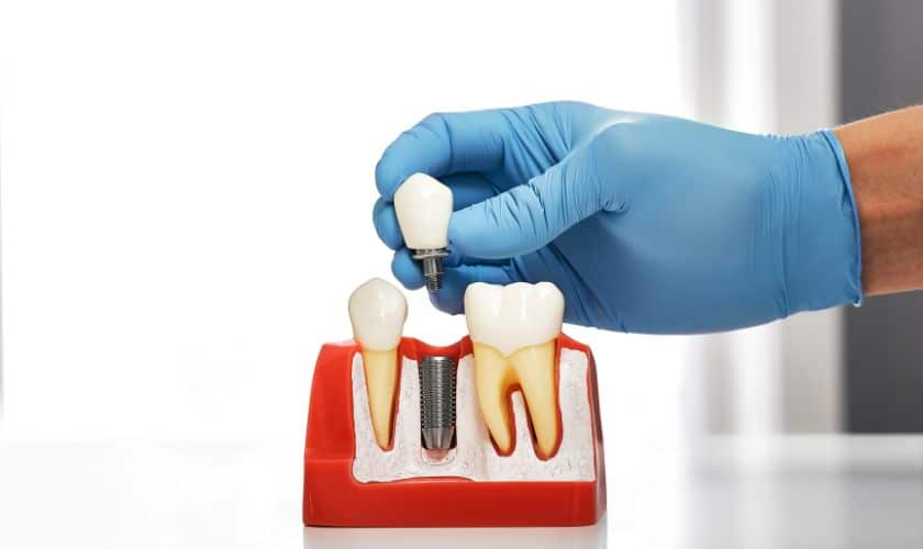 Choosing the Right Dental Implant Specialist: Factors to Consider