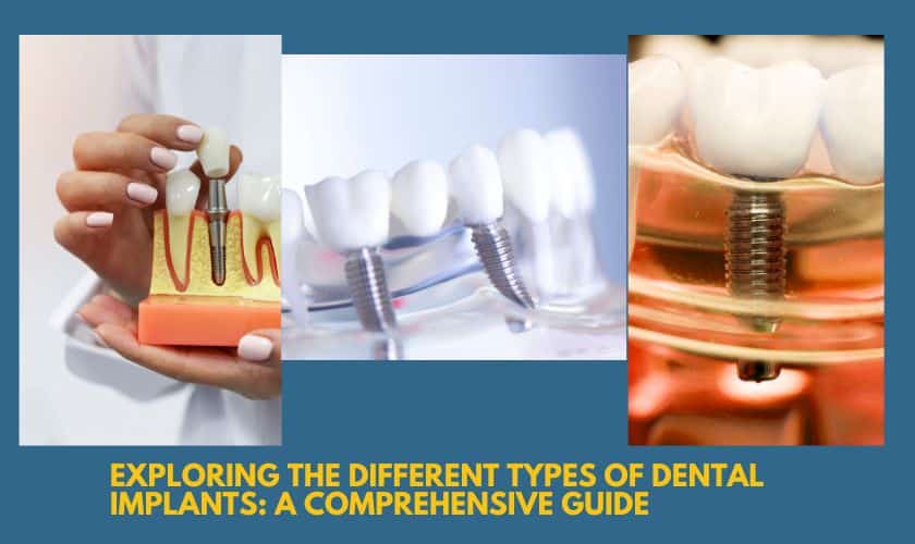 Exploring the Different Types of Dental Implants: A Comprehensive Guide