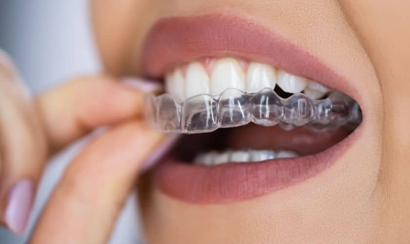 How Does Invisalign Work? Here’s The Procedure Step-by-Step Guide